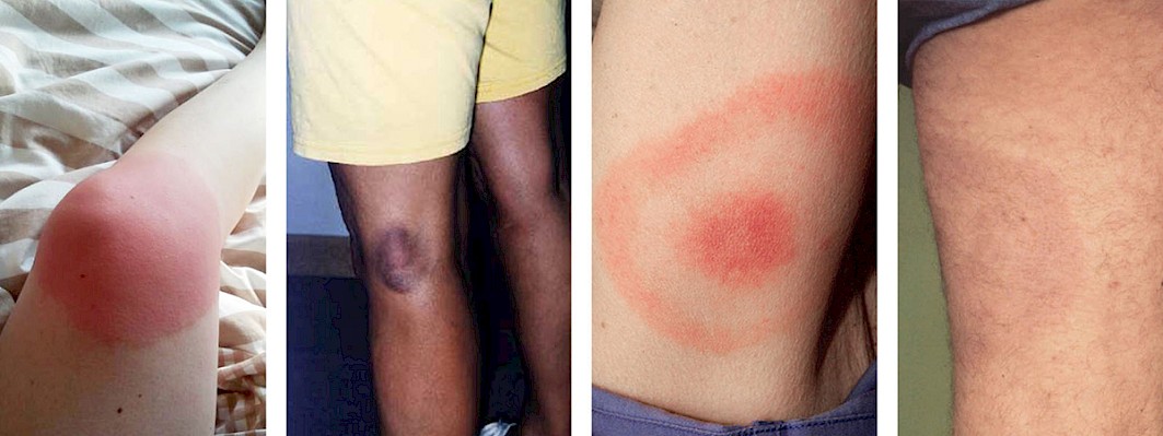 Erythema migrans (EM), een rode vlek, kring of ring bij de ziekte van Lyme